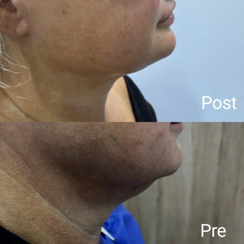 تحديد الفك بالخيوط